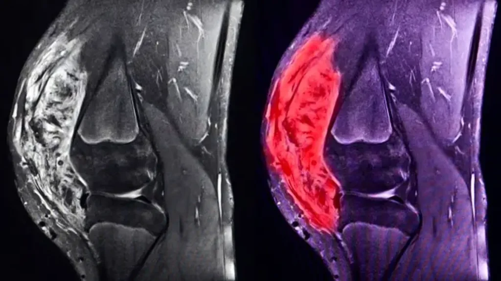 SARCOMA