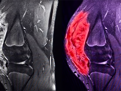 CT Scan of tumor